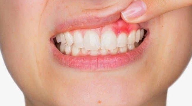 “Sigara, periodontitis için bir risk faktörüdür”