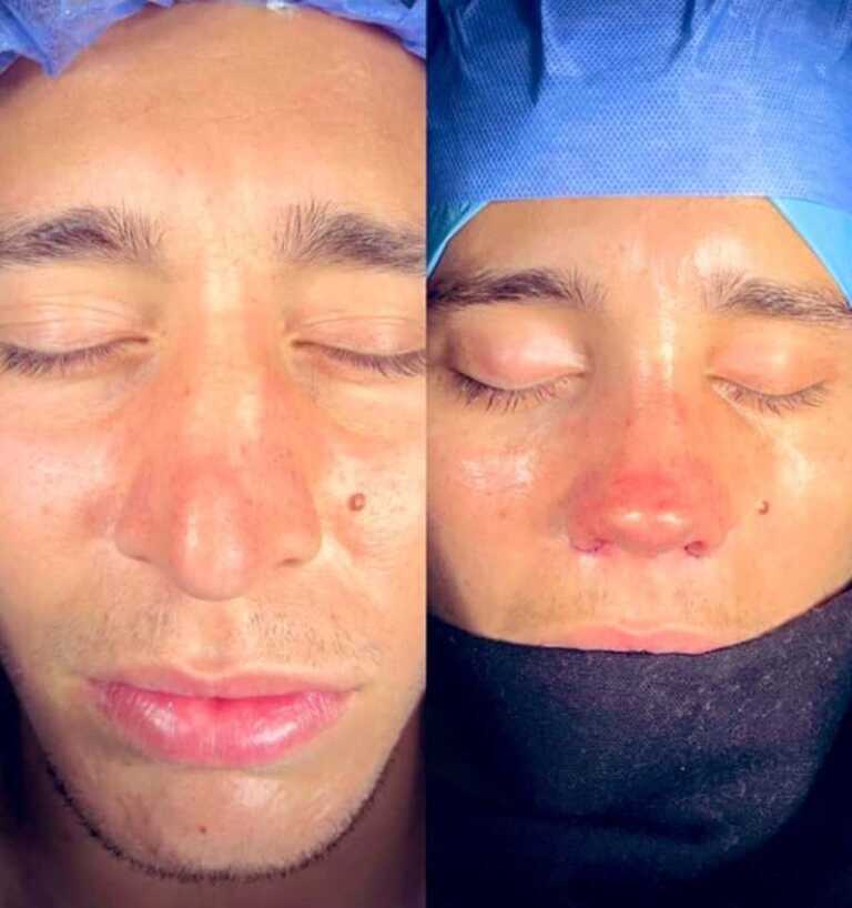 Emre Mor Burun Estetiği Yaptırdı