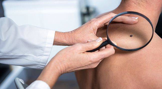 Gençlerde En Sık Görülen Kanser Türü: Deri Kanseri