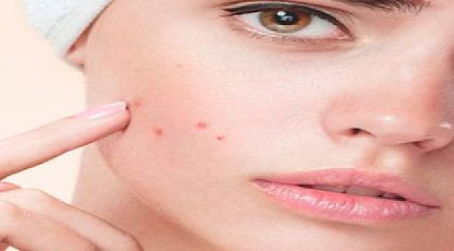 Kadınlara oranla erkeklerde daha az akne problemi yaşanıyor