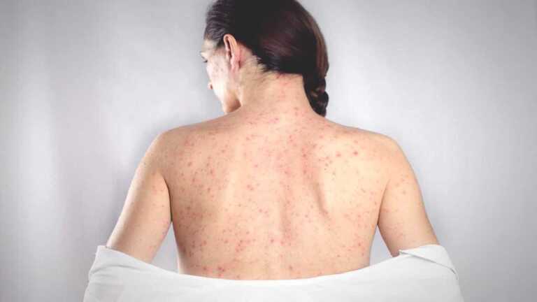 Türkiye’de Artan Kızamık Vakaları Yetişkinleri de Etkiliyor